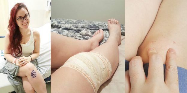 Cirurgia do joelho: como foi a operação do menisco (meniscectomia), o pós operatório e a recuperação.